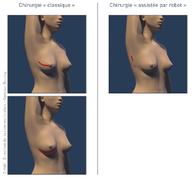 Chirurgie robotique au niveau du sein a été mise au point par le Dr Benjamin Sarfati, chirurgien esthétique à Paris