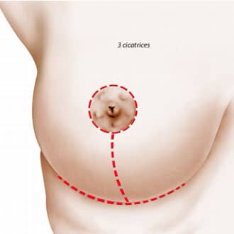 Un sein montrant les différentes cicatrice du lifting mammaire Dr Benjamin Sarfati paris