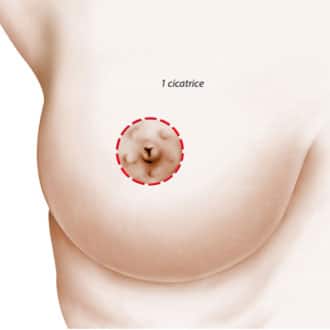 Dessin de sein montrant les differentes cicatrice du lifting mammaire Dr Benjamin Sarfati paris