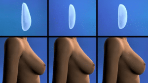 Comment déterminer le volume de l'implant mammaire