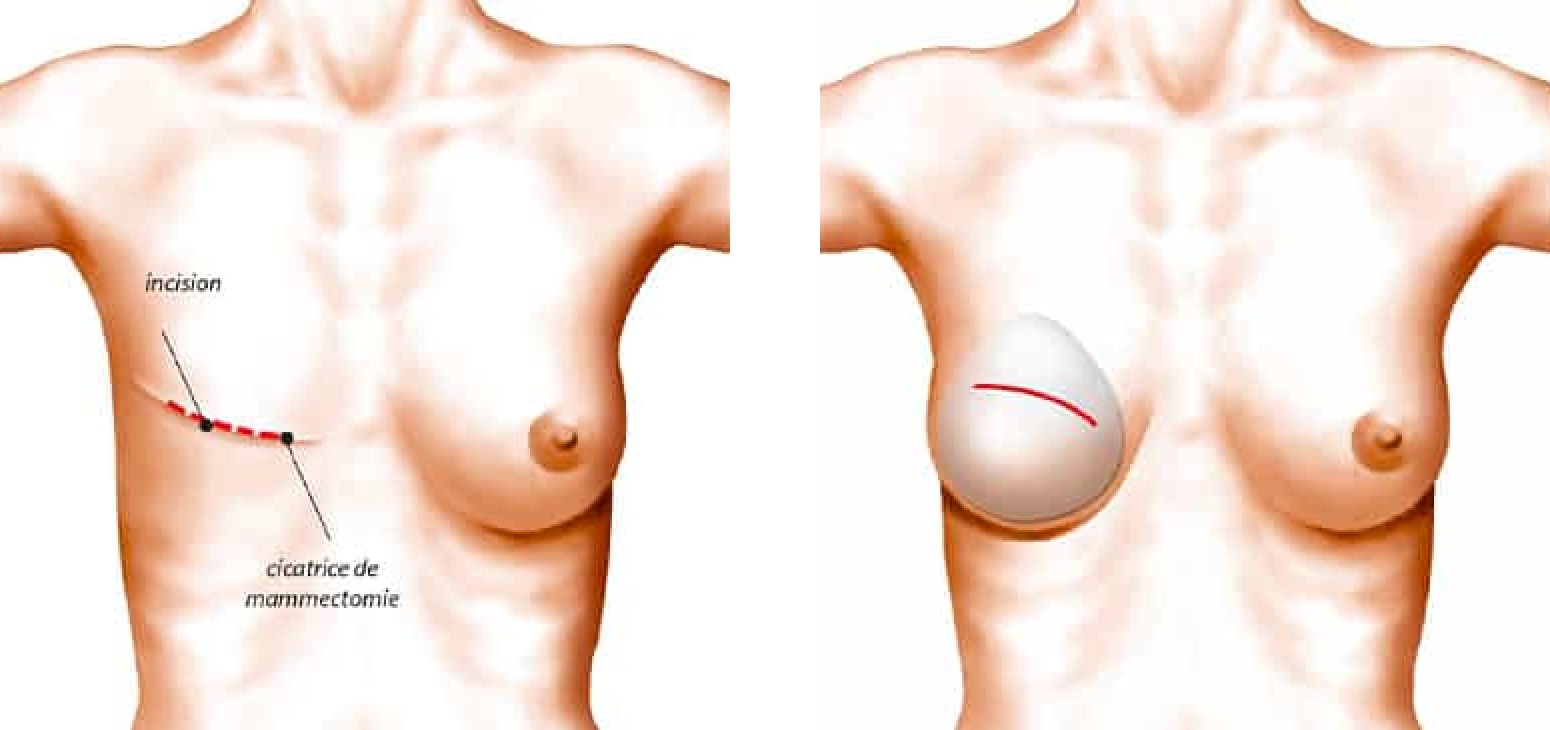 Reconstruction mammaire par prothèse à Paris | Dr B. Sarfati