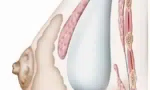 Image de prothèse mammaire placée derrière le muscle