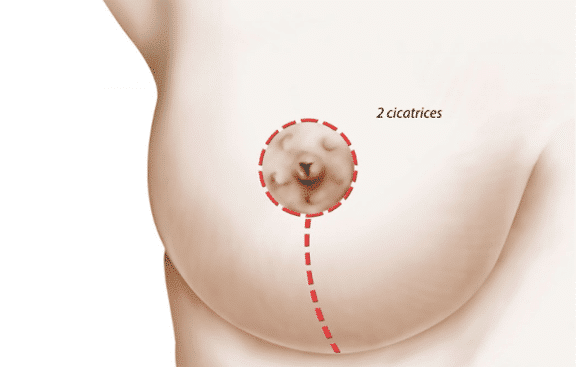 réduction mammaire, deux cicatrice, Dr Sarfati