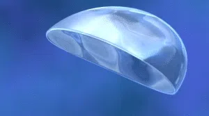 Les types de prothèses mammaires ayant une durée de vie supérieure