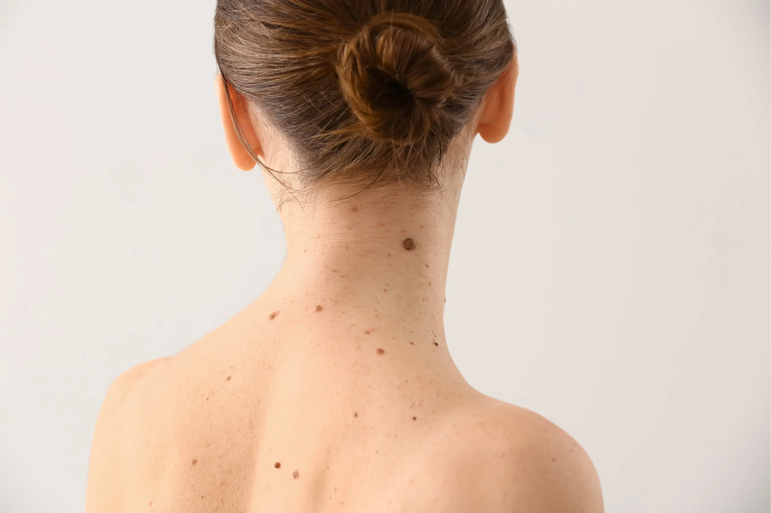 Skin cancers (basal cell carcinoma) | Paris | Dr B. Sarfati