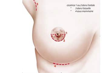 Le chirurgien peut positionner la cicatrice à trois endroits : autour de l’aréole, au niveau du sillon sous mammaire ou au niveau de l’aisselle
