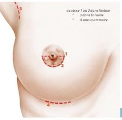 Les différentes cicatrices lors d'une augmentation mammaire