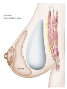 Prothèse mammaire placée en avant du muscle