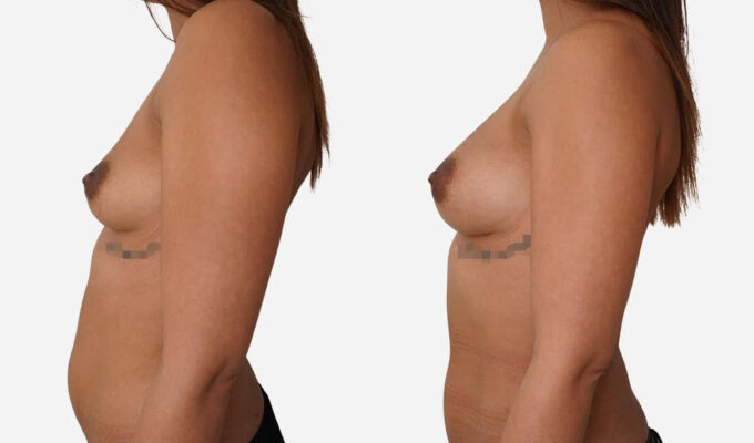 Lipofilling mammaire ( injection de graisse) 400 cc de graisse de chaque côté | Dr Benjamin Sarfati | Paris