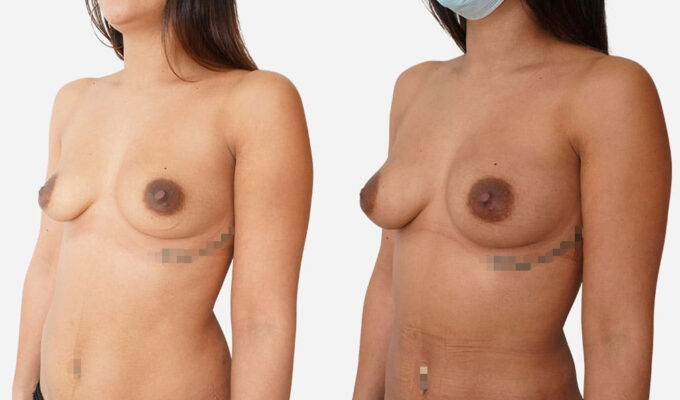 Augmentation mammaire par lipofilling | Dr Benjamin Sarfati | Paris