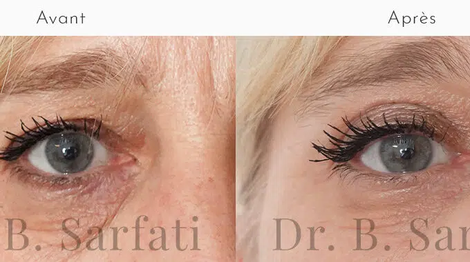 Oeil de femme avant et apres blepharoplastie superieure chirurgie esthetique des paupieres Dr Benjamin Sarfati paris