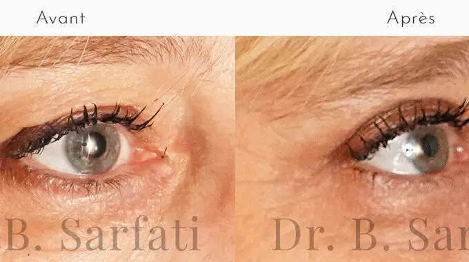 Oeil de femme avant et apres blepharoplastie superieure pour retirer l excedent de la peau Dr Benjamin Sarfati paris