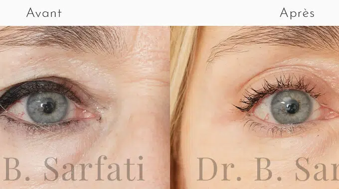 Oeil de femme avant et apres blepharoplastie paupiere superieure et inferieure Dr Benjamin Sarfati paris