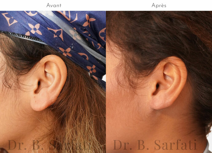 La chirugie du lobe des oreilles à Paris Technique et tarifs Dr B — free download