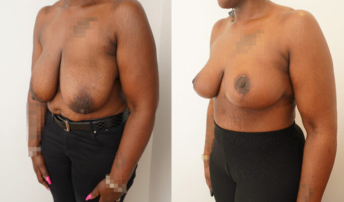 Breast Reduction  La Clinique Privée