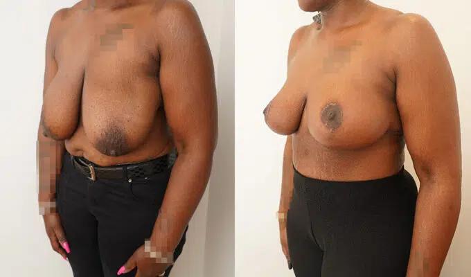 Poitrine avant et apres reduction mammaire bilateral Dr benjmin Sarfati Paris