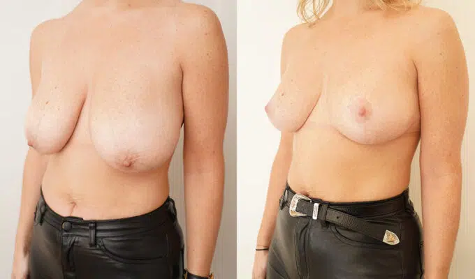 Poitrine avant et apres reduction mammaire par laser urgotouch Dr Benjamin Sarfati paris