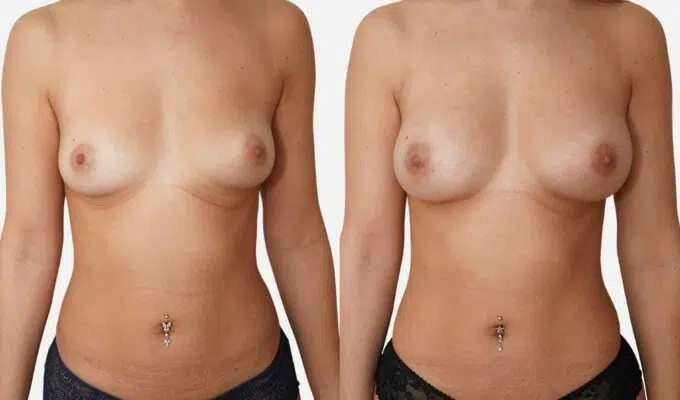 Poitrine avant et apres une augmentation mammaire par injection de graisse Lipofilling Dr Benjamin Sarfati paris