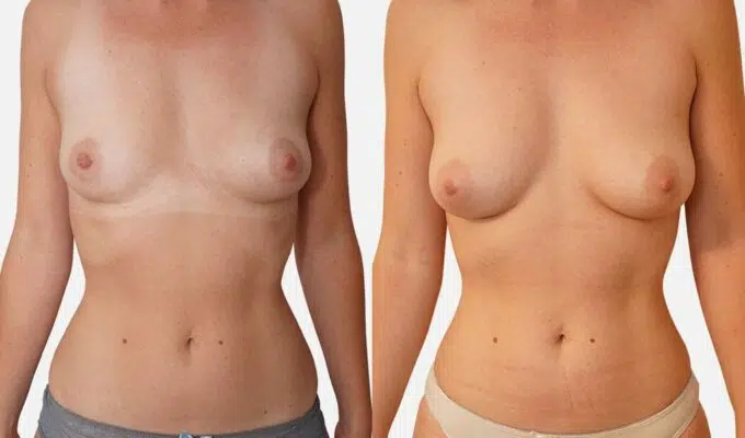 Poitrine de femme avant et apres une augmentation mammaire par injection de graisse Lipofilling Dr Benjamin Sarfati paris