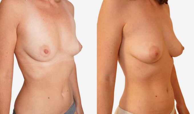 Augmentation mammaire par lipofilling (injection de graisse) | Dr Benjamin Sarfati | Paris