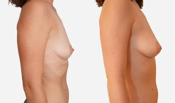 Poitrine de femme avant et apres une augmentation mammaire par injection de graisse Lipofilling Dr Benjamin Sarfati paris