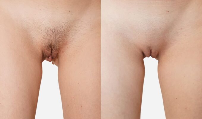 Partie intime de femme avant et apres Interventions esthetique pour l intime Dr Benjamin Sarfati paris