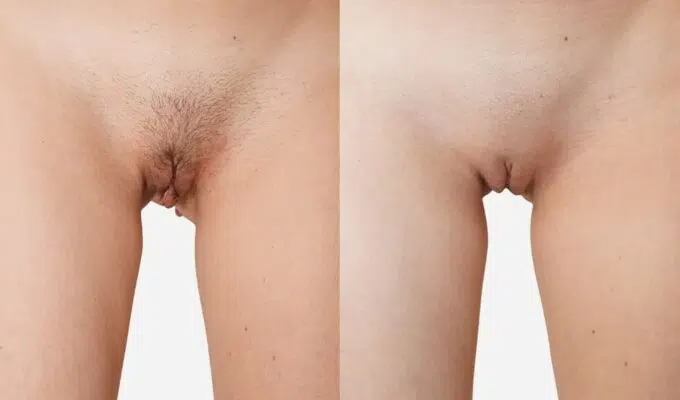 Female intimate area before and after cosmetic procedures for the intimate area Dr. Benjamin Sarfati Paris