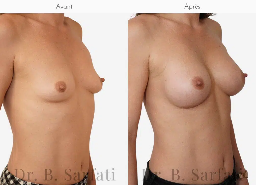 Poitrine de femme avant et apres une augmentation mammaire par prothese Dr Benjamin Sarfati paris