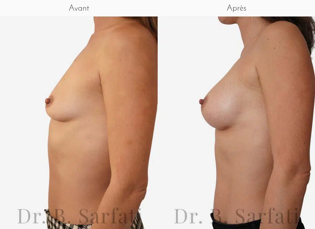Poitrine de profile avant et apres une augmentation mammaire par prothese Dr Benjamin Sarfati paris