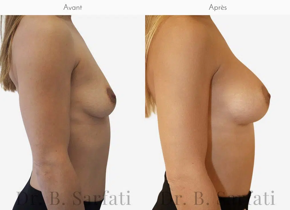 Poitrine de femme de profile  avant et apres une augmentation mammaire par prothese Dr Benjamin Sarfati paris