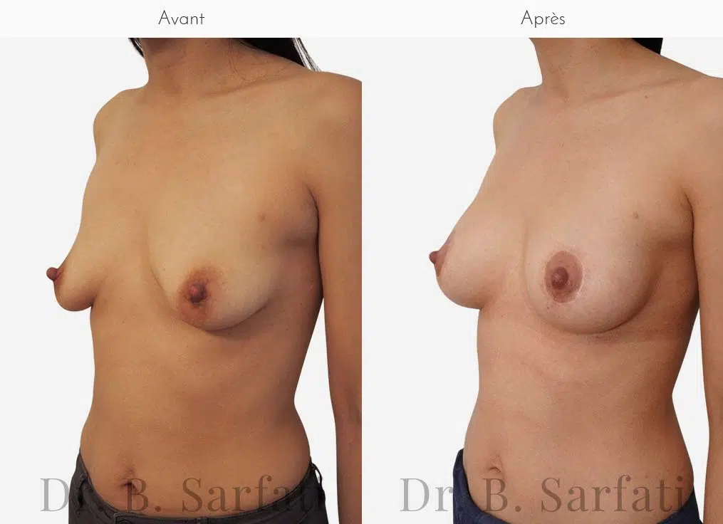Poitrine avant et apres une augmentation mammaire par prothese ronde Dr Benjamin Sarfati paris