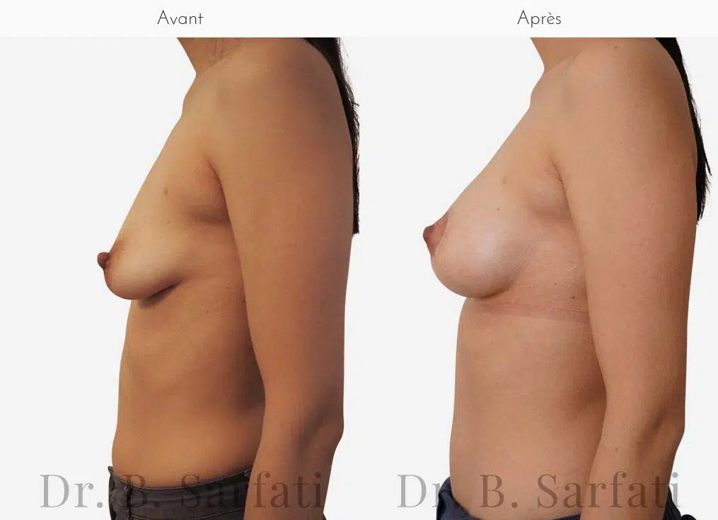 Poitrine de femme avant et apres une augmentation mammaire par prothese ronde Dr Benjamin Sarfati paris