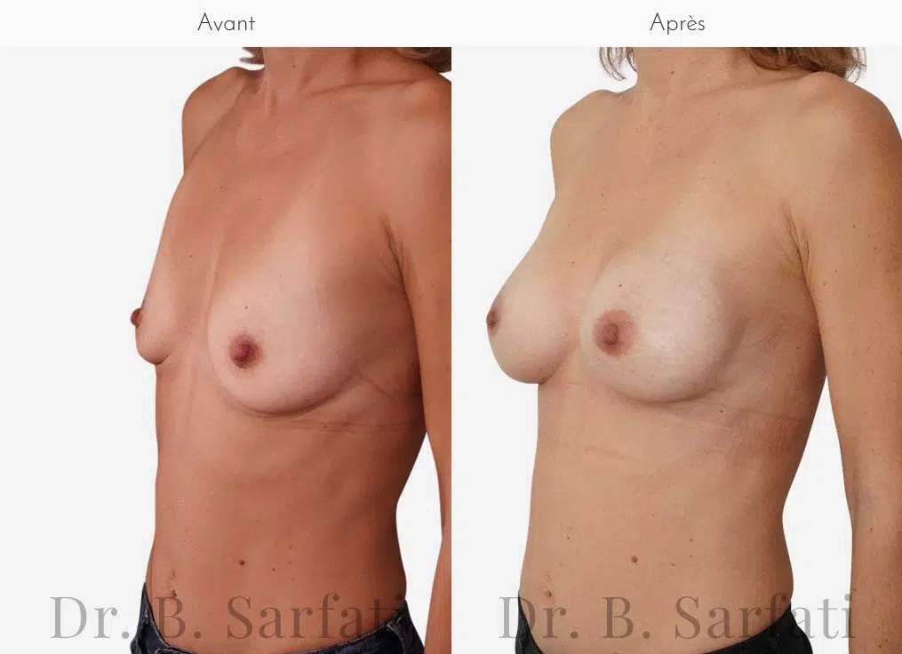 Poitrine avant et apres une augmentation mammaire par prothese ronde Dr Benjamin Sarfati paris