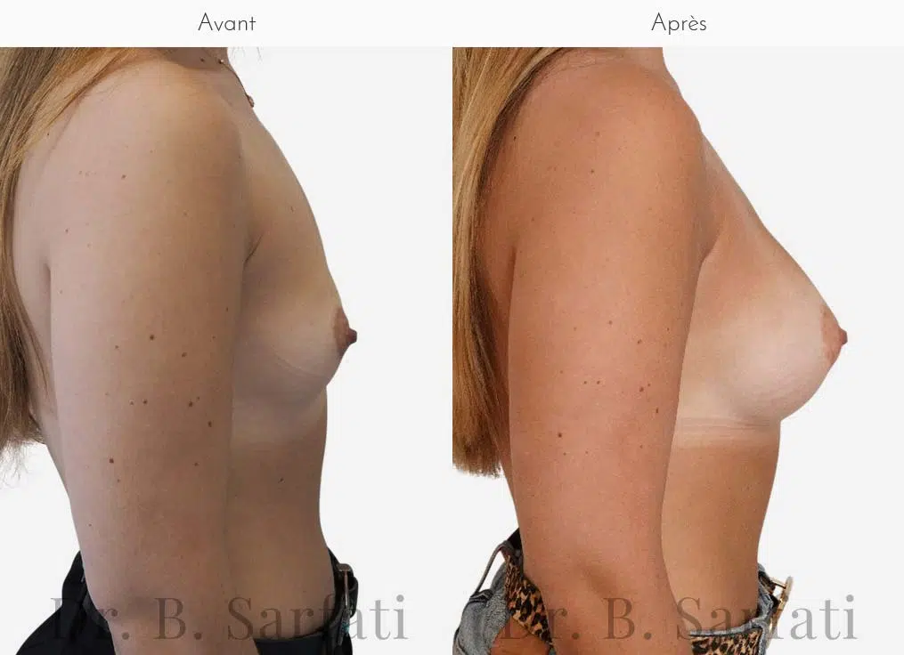 Poitrine de femme avant et apres une augmentation mammaire par prothese ronde Dr Benjamin Sarfati paris