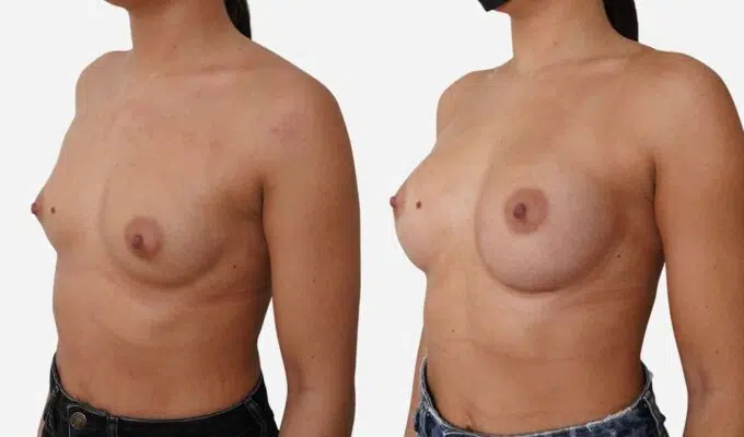 Poitrine de femme avant et apres une augmentation mammaire par prothese et cicatrice sous mammaire Dr Benjamin Sarfati paris