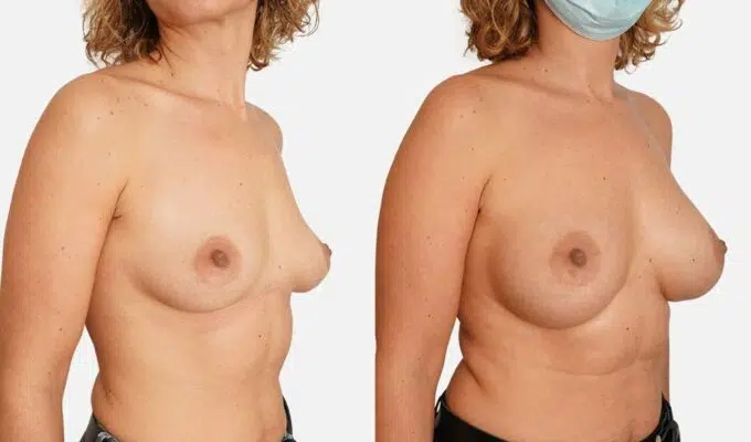 Poitrine avant et apres une augmentation mammaire par prothese en dual plan Dr Benjamin Sarfati paris