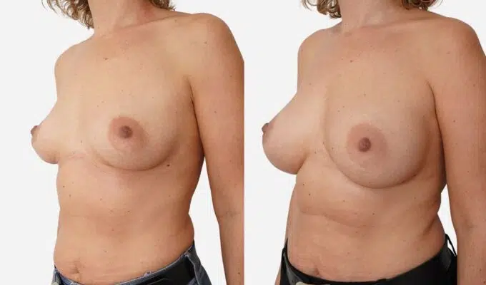 Poitrine de femme avant et apres une augmentation mammaire par prothese en dual plan Dr Benjamin Sarfati paris