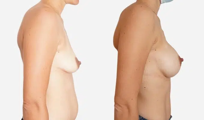 Poitrine avant et apres une augmentation mammaire par prothese de 340cc place en dual plan Dr Benjamin Sarfati paris