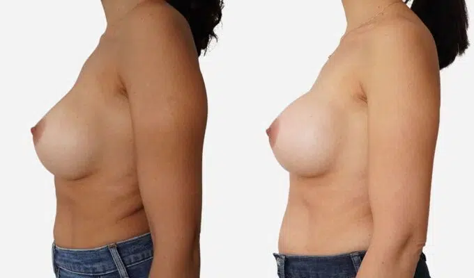 Poitrine de femme avant et apres une augmentation mammaire par prothese en dual plan Dr Benjamin Sarfati paris