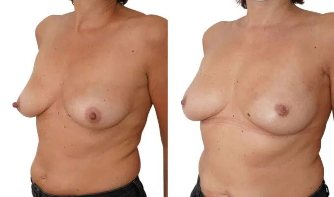 Poitrine de femme avant et apres mastectomie gauche par voie sous mammaire Dr Benjamin Sarfati paris