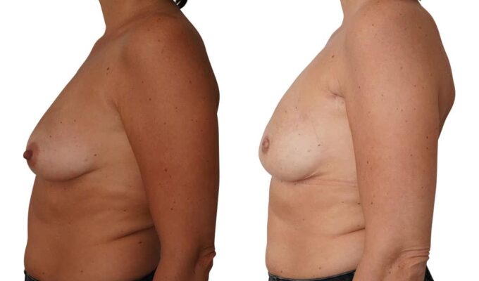 Areola preservation and immediate breast reconstruction with an implant placed in front of the pectoral muscle and symmetry of the left breast