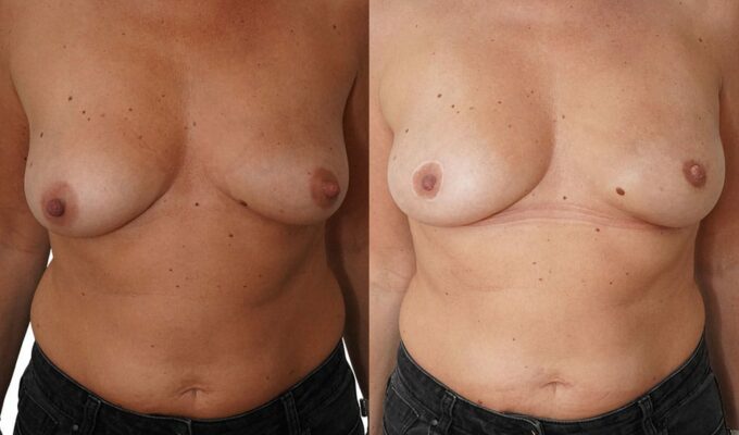 Female chest front view before and after left breast mastectomy via inframammary approach Dr. Benjamin Sarfati Paris