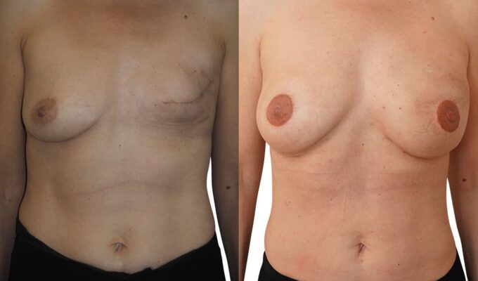 Female chest before and after secondary breast reconstruction by prosthesis and injection Dr Benjamin Sarfati Paris