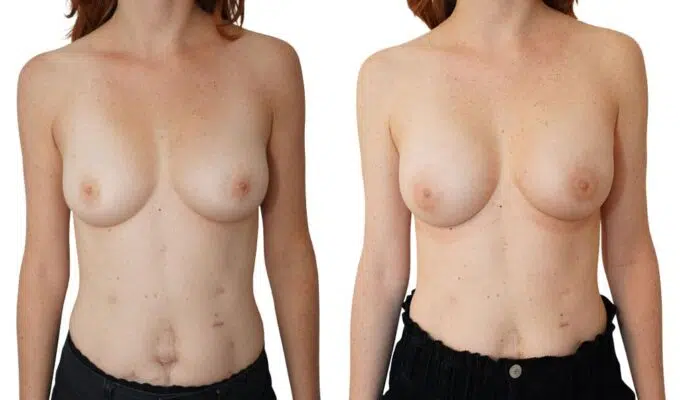 Poitrine de femme avant et apres mastectomie bilaterale avec conservation de l areole Dr Benjamin Sarfati paris