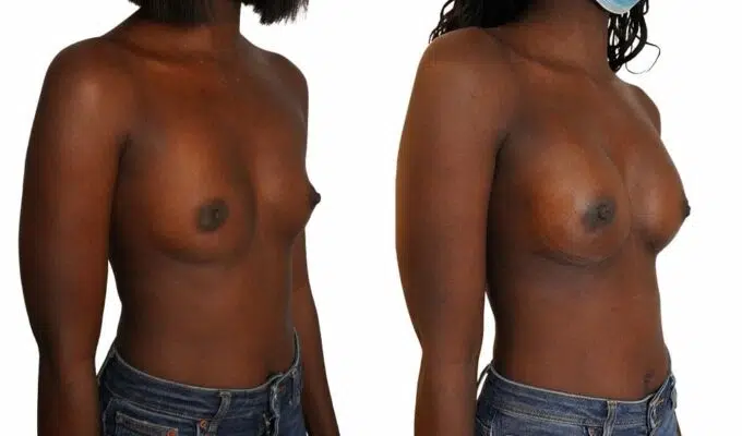Poitrine de femme avant et apres mastectomie bilaterale avec conservation de l areole Dr Benjamin Sarfati paris
