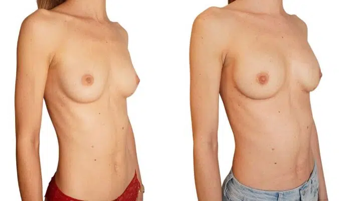 Poitrine avant et apres mastectomie prophylactique bilaterale Dr Benjamin Sarfati paris