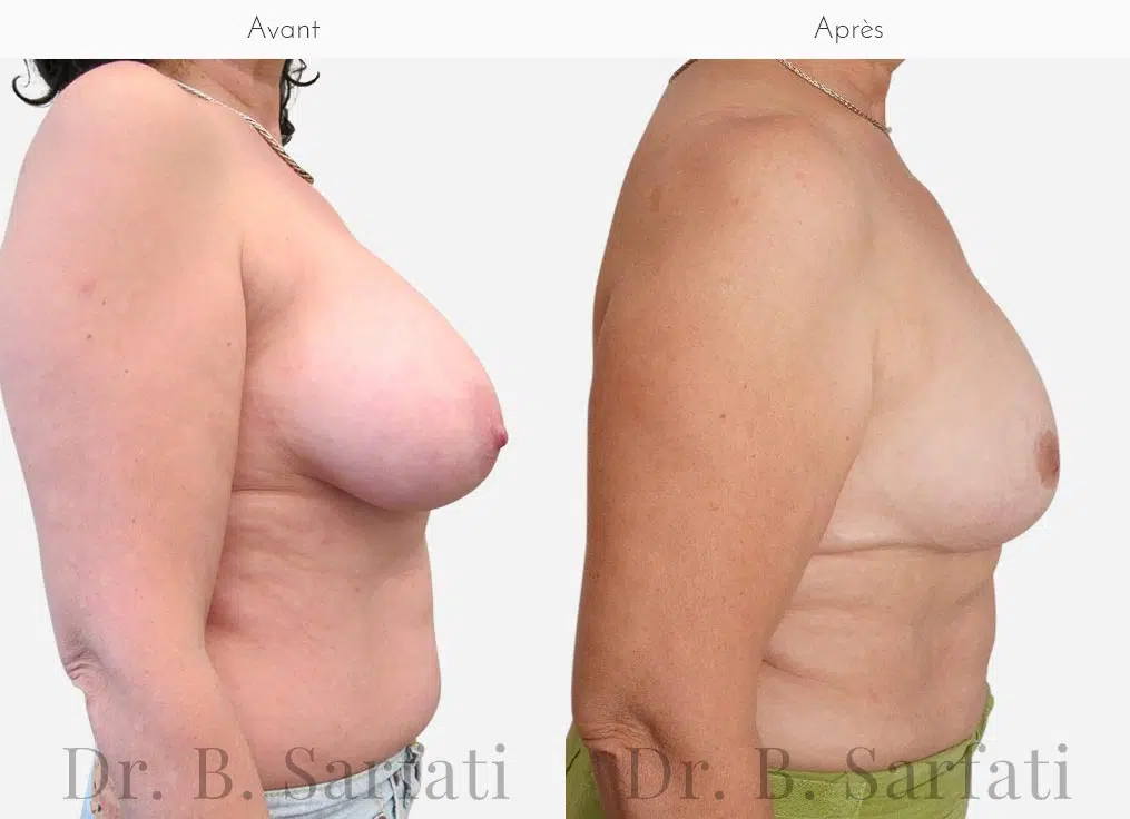 Poitrine avant et apres reduction mammaire bilaterale Dr benjmin Sarfati Paris