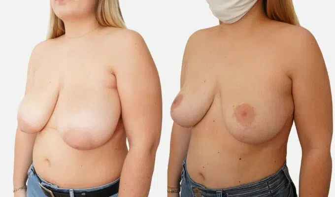 Poitrine de femme avant et apres reduction mammaire bilaterale avec cure de ptose mammaire Dr benjmin Sarfati Paris