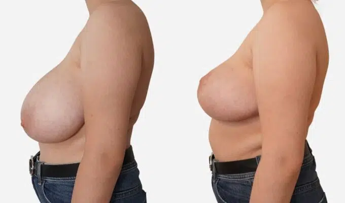 Poitrine de prfile droit avant et apres reduction mammaire bilaterale avec cicatrice en T inverse Dr benjmin Sarfati Paris