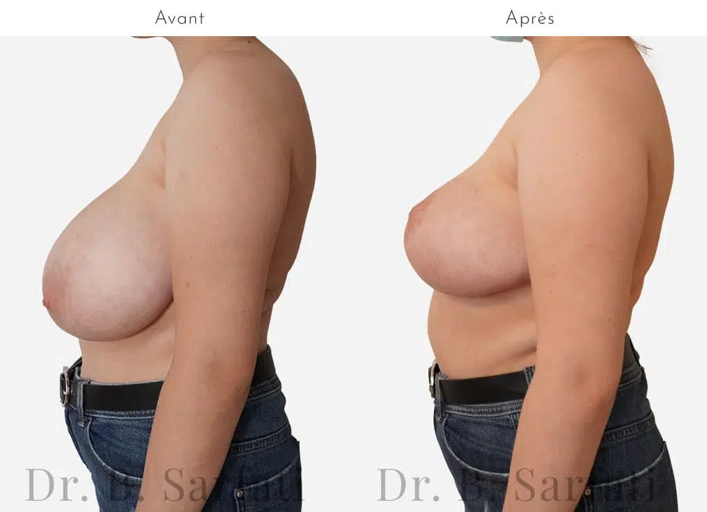 Poitrine de prfile droit avant et apres reduction mammaire bilaterale avec cicatrice en T inverse Dr benjmin Sarfati Paris